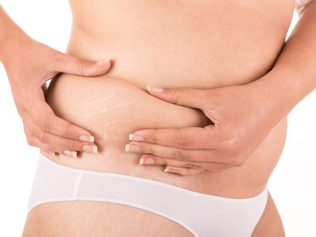 Estrías, ¿sí o no?