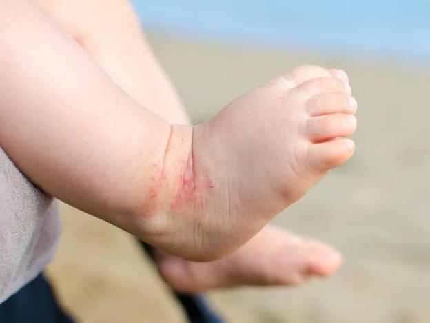 Sarpullidos en verano: ¿Qué es la sudamina?