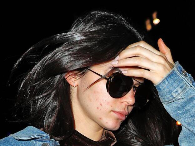 5 cosas que debes saber si padeces acné adulto con frecuencia