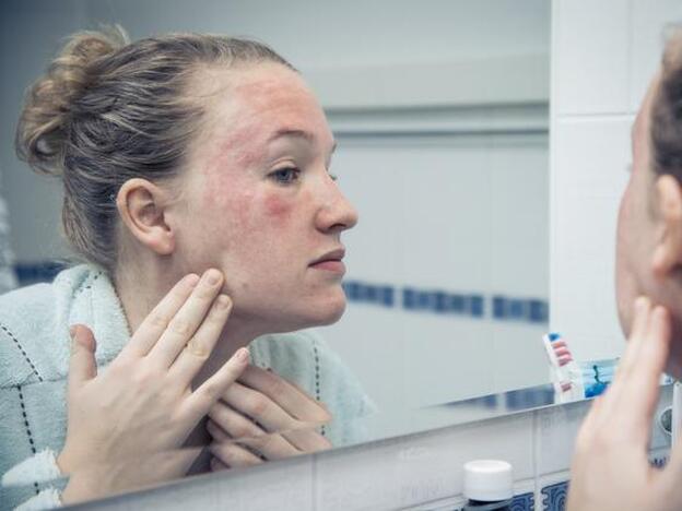 Dermatitis atópica: cómo tratarla