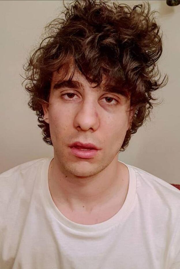 Así tiene la cara Javier Calvo tras la agresión en Lisboa