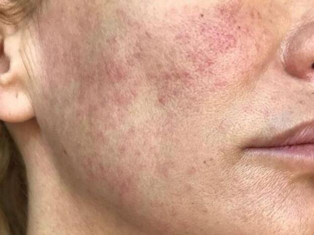 ¿Qué es la rosácea?Todo lo que necesitas saber