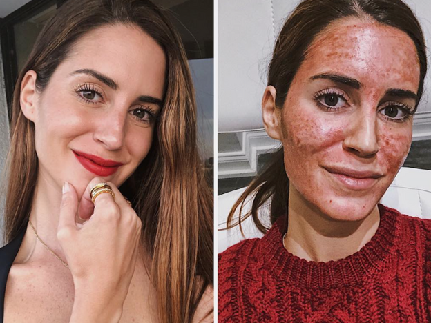 Gala González se apunta al tratamiento más sangriento: el facial vampiro