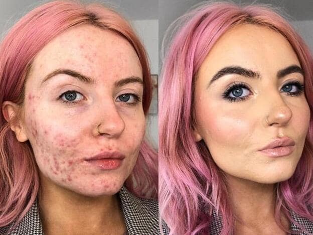 Esta bloguera de Instagram sí sabe cómo disimular el acné | Mujer Hoy