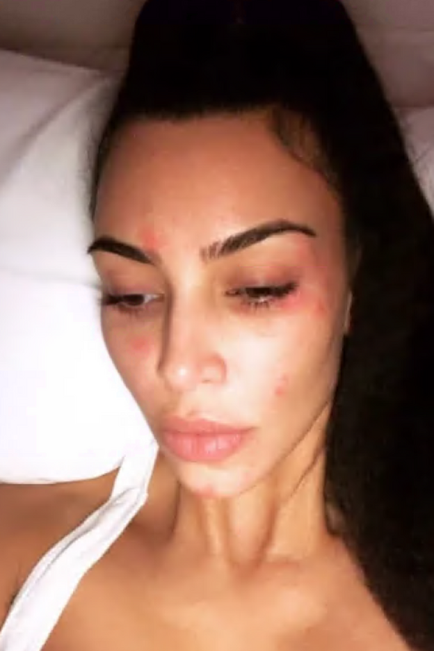 El aspecto de la piel de Kim Kardashian con psoriasis.