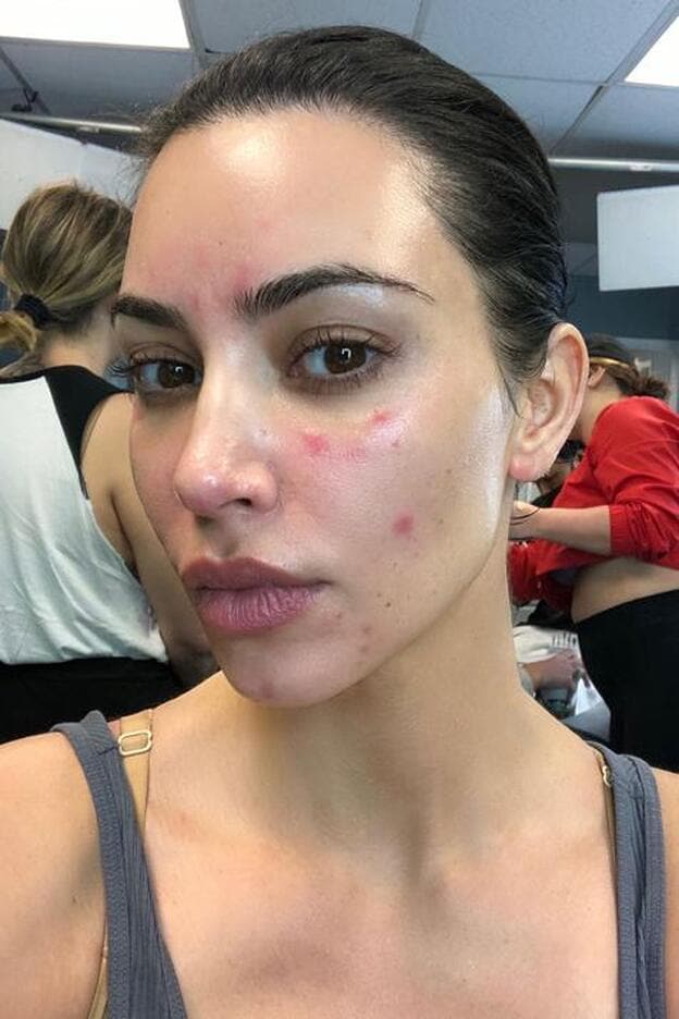  Kim Kardashian muestra la psoriasis de su cara por primera vez