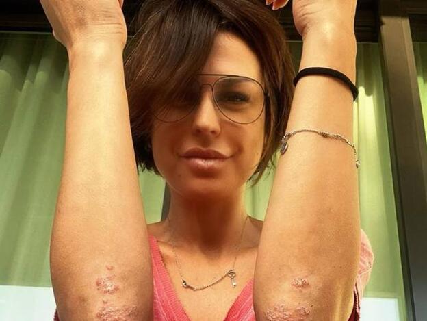 La enfermedad que padece Raquel Perera y de la que pretende concienciar con esta foto